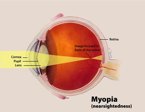 A color illustration of myopia highlighting the cornea, pupil and lens, and the way an image focuses in front of the retina.