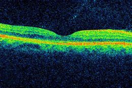 DME, as viewed by optical coherence tomography (OCT). The two images were taken before (Top) and after anti-VEGF treatment (Bottom). The dip in the retina is the fovea, a region of the macula where vision is normally at its sharpest. Note the swelling of the macula and elevation of the fovea before treatment.