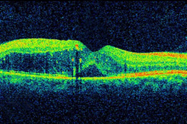 DME, as viewed by optical coherence tomography (OCT). The two images were taken before (Top) and after anti-VEGF treatment (Bottom). The dip in the retina is the fovea, a region of the macula where vision is normally at its sharpest. Note the swelling of the macula and elevation of the fovea before treatment.