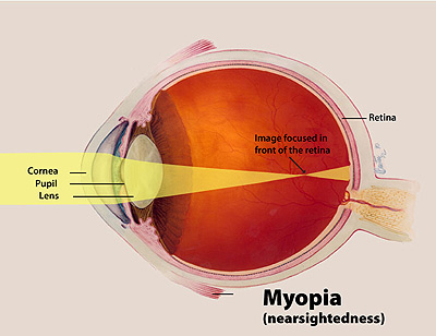 Myopia.