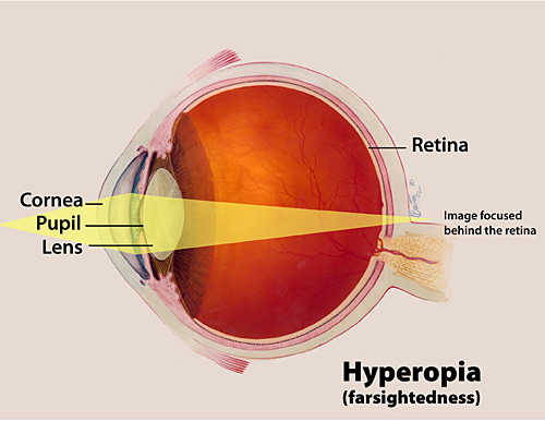 A color illustration of hyperopia highlighting the cornea, pupil and lens, and the way an image focuses behind the retina.