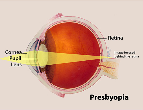 A color illustration of presbyopia highlighting the cornea, pupil and lens, and the way an image focuses behind the retina.