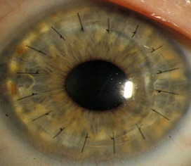 A full thickness corneal transplant, with the sutures still visible.