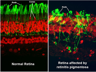 Retinitis pigmentosa; Retinopatía Pigmentaria; Distrofia ... rods eye diagram 