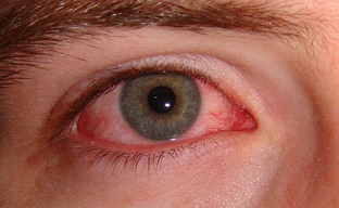 Pink Eye image