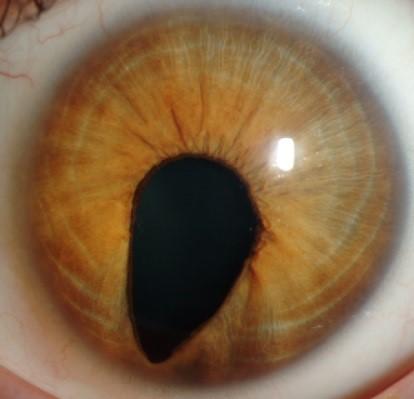 Coloboma | National Eye Institute